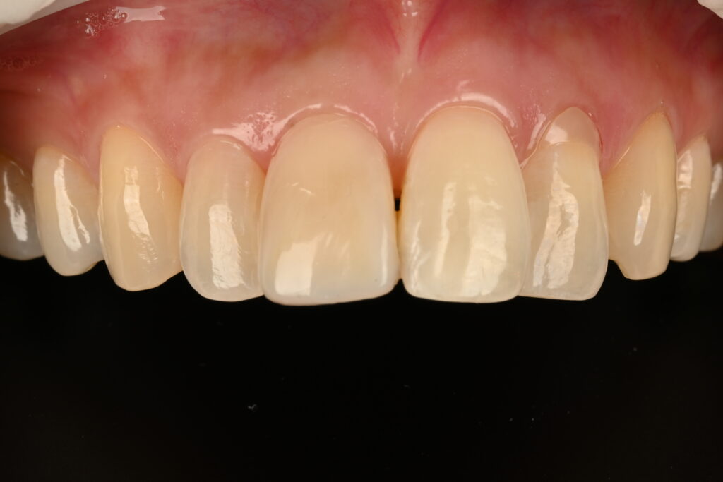 레진라미네이트